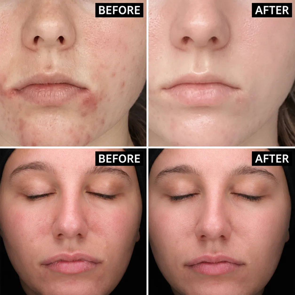 Sakura Essence Clarifying Acne Skincare Set (12pcs) - Beautyturess